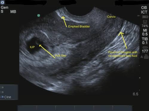 Transvaginal ultrasound